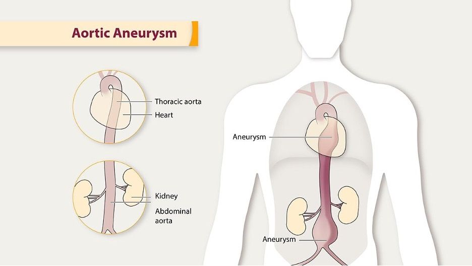 aortic aneurysm